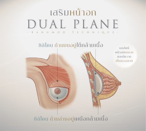 หน้าอกเป็นคลื่นริ้ว (Rippling) แก้ได้ อย่าตระหนก!